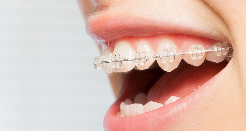 Niềng răng mắc cài sứ là phương pháp niềng răng sâu an toàn