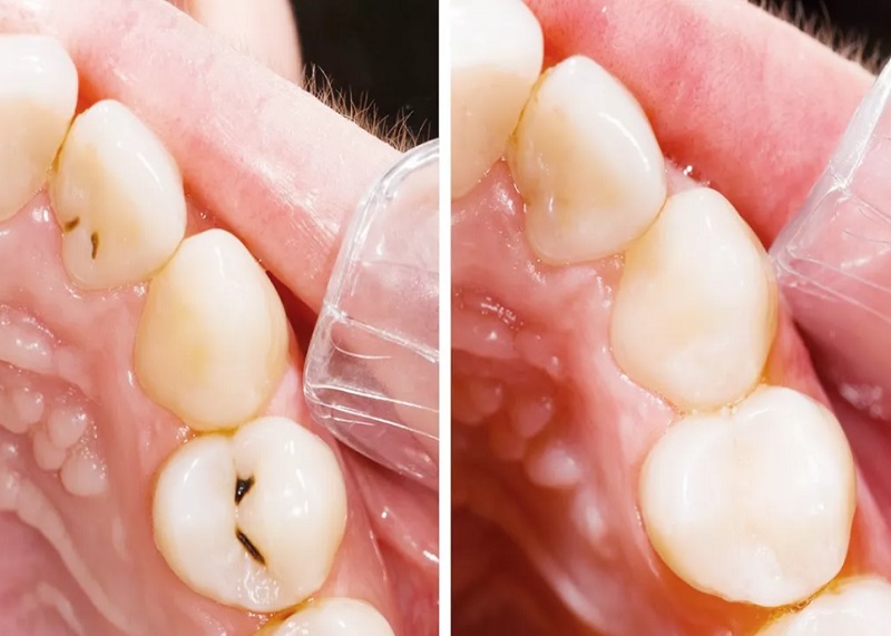 Thân răng bị vỡ sẽ không thể thực hiện niềng răng