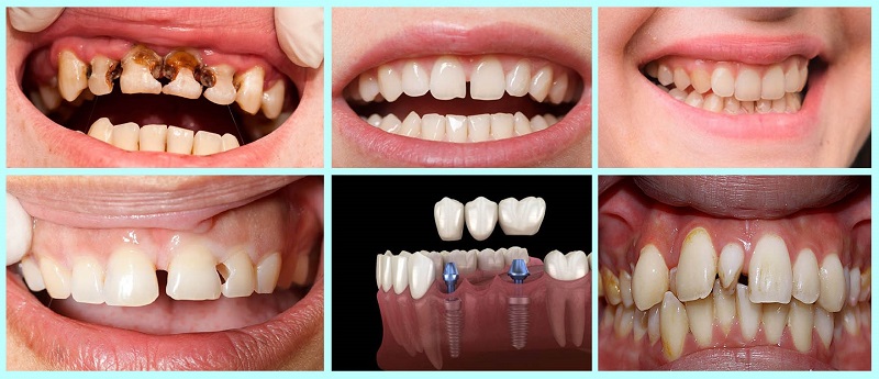 Răng sứ toàn sứ HT Smile có thể cải thiện nhiều điểm khiếm khuyết trên hàm răng