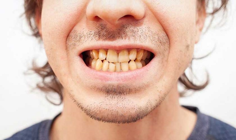 Tỷ lệ cha mẹ di truyền màu răng ố vàng sang con là rất cao, tình trạng này không thể cải thiện bằng những phương pháp tẩy trắng răng thông thường