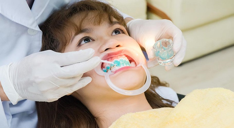 Cần có khoảng thời gian trống sau mỗi lần tẩy trắng răng để men răng ổn định và phục hồi