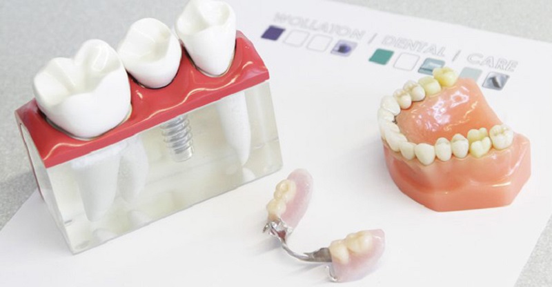 Bạn có thể phục hình răng bằng 3 phương pháp chủ yếu: Làm hàm giả tháo lắp, làm cầu răng sứ và trồng răng Implant