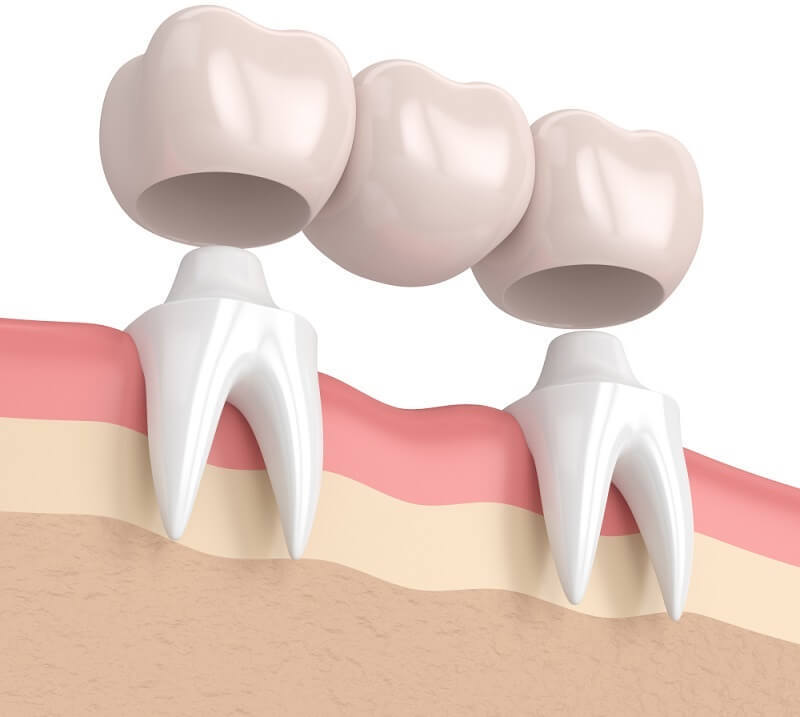 Cầu răng sứ là giải pháp phục hình răng cố định, giúp che lấp khoảng trống trên cung hàm do bị mất răng