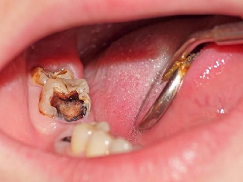 Răng cối là gì? Vai trò của răng cối trong cung hàm 11 Sâu răng cối