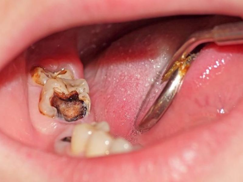 Răng khôn mọc sai vị trí sẽ làm vệ sinh khó khăn và gây sâu răng
