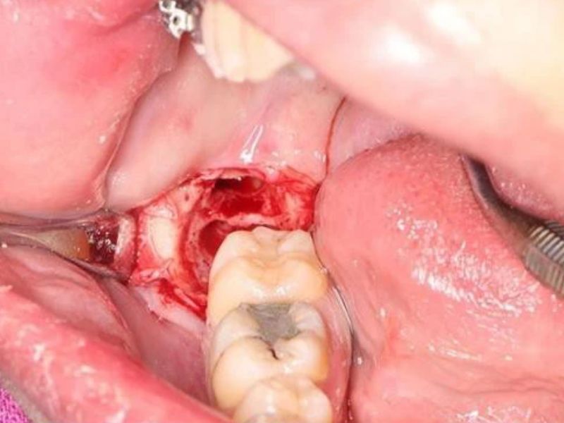 Bác sĩ không có tay nghề thực hiện nhổ răng khôn có thể gây nhiễm trùng, sưng vùng nướu