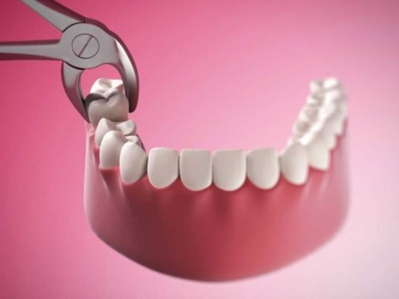 Nhổ răng khôn không đúng kỹ thuật sẽ tác động và ảnh hưởng tới răng số 7