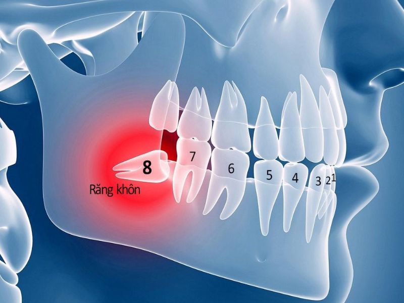 Thực hiện nhổ răng khôn ở những cơ sở nha khoa không uy tín có thể sẽ gặp phải tình trạng sốc phản vệ
