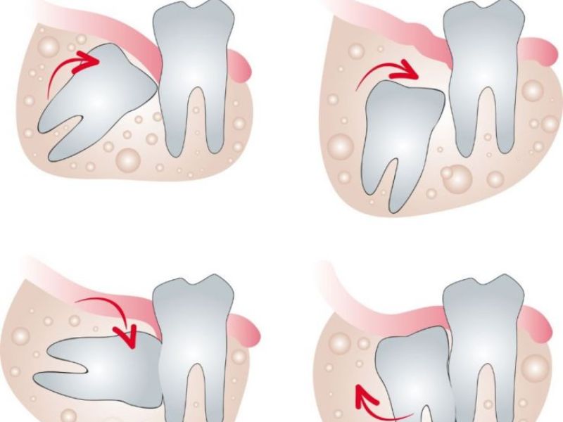 Răng khôn mọc lệch, mọc ngầm, sai vị trí thì cần phải nhổ bỏ để không gây ảnh hưởng tới các răng bên cạnh và sức khỏe răng miệng
