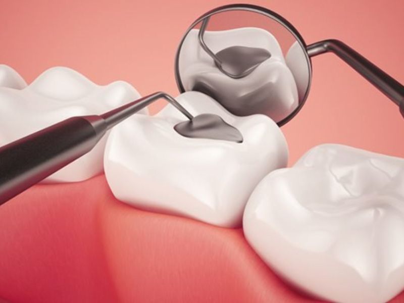 Hàn trám răng giúp răng bị mẻ cải thiện chức năng thẩm mỹ hiệu quả