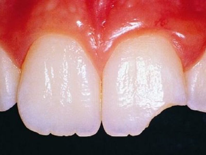 Răng bị mẻ thường do lực tác động mạnh từ bên ngoài gây tổn thương men răng