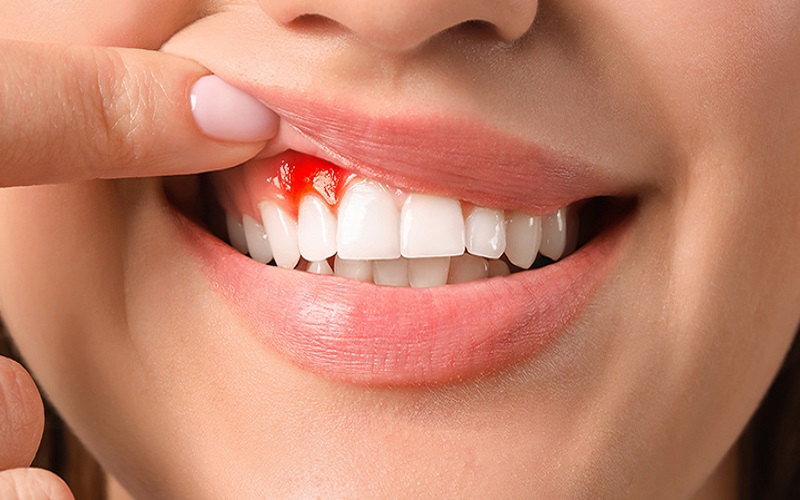 Tình trạng chảy máu răng là triệu chứng của các bệnh lý viêm nha chu, viêm nướu