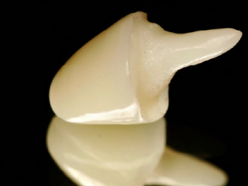 Cùi răng sứ toàn sứ có tính thẩm mỹ cao và tuổi thọ lên tới 20 năm