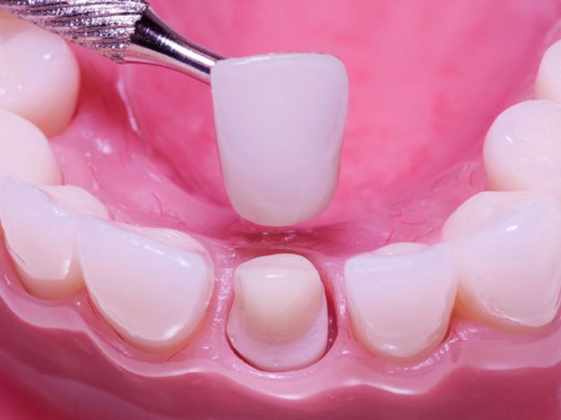 Làm cùi răng sứ giả giúp hạn chế tình trạng tiêu xương và ngăn ngừa các bệnh lý hiệu quả