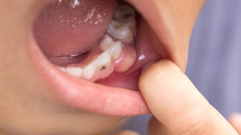Tình trạng áp xe chân răng hình thành chủ yếu do chân răng bị chảy máu trong thời gian dài, thậm chí xuất hiện túi mủ