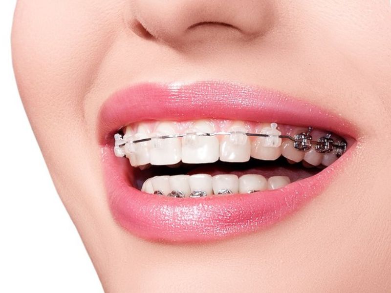 Niềng răng thẩm mỹ giúp cải thiện hiệu quả tình trạng lệch mặt do sai khớp cắn