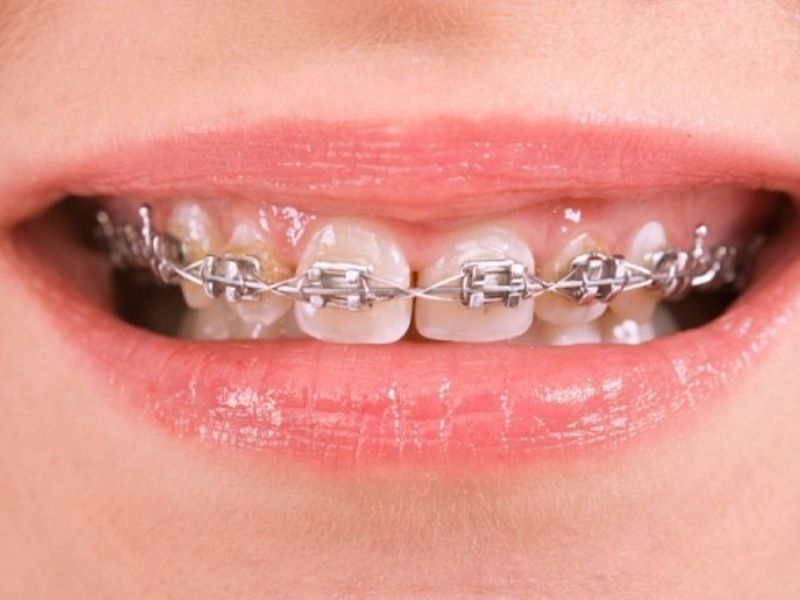 Siết răng từ 3 - 6 tuần/1 lần đối với niềng răng mắc cài bình thường
