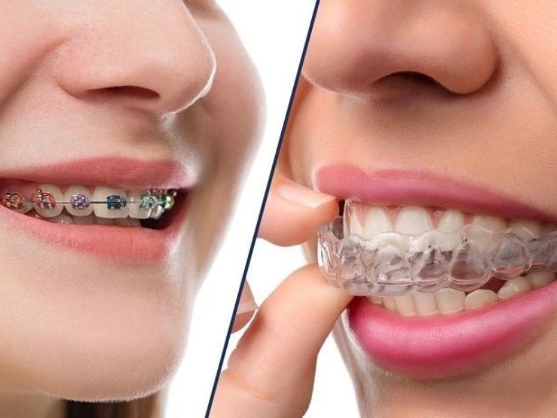 Những người giao tiếp nhiều vẫn có thể cải thiện khuyết điểm trên răng bằng phương pháp niềng răng