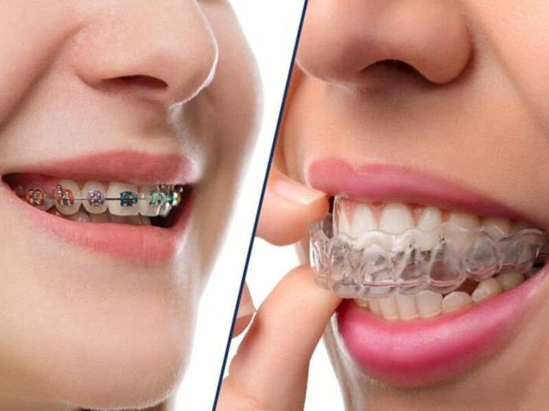 Niềng răng giúp cải thiện tình trạng răng mọc lệch lạc, sai vị trí