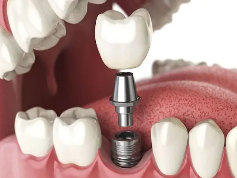 Trồng răng Implant giúp cải thiện khuyết điểm mất răng hiệu quả