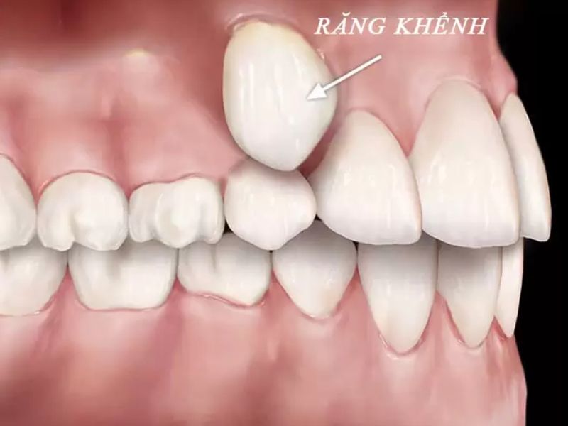 Răng khểnh sẽ mọc lệch ra phía ngoài hoặc lệch vào phía trong từ 5 - 10 độ