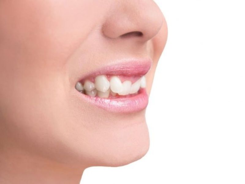 Quá trình mọc răng khểnh kéo dài từ 2 - 4 tuần hoặc có thể lâu hơn