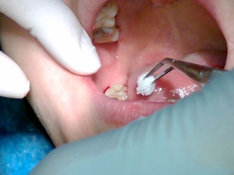 Khi răng số 8 mọc lệch có thể gây ra viêm lợi trùm răng khôn và nhiễm trùng nướu