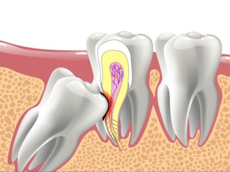Răng số 8 mọc lệch, đâm ra má có thể gây phá hủy răng số 7 nghiêm trọng