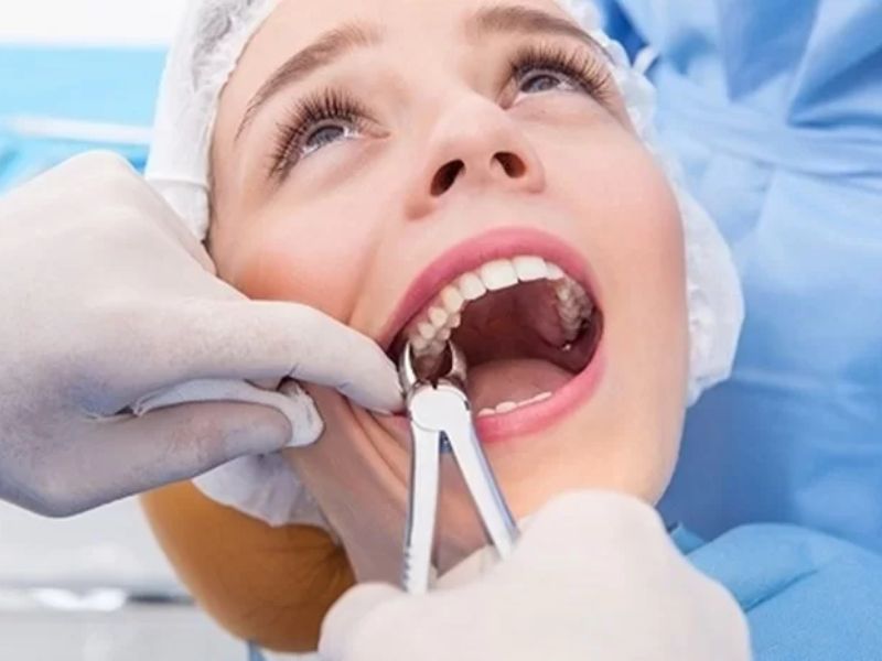 Nếu răng khôn mọc lệch về phía má, bác sĩ chỉ định nên nhổ răng để hạn chế biến chứng xảy ra