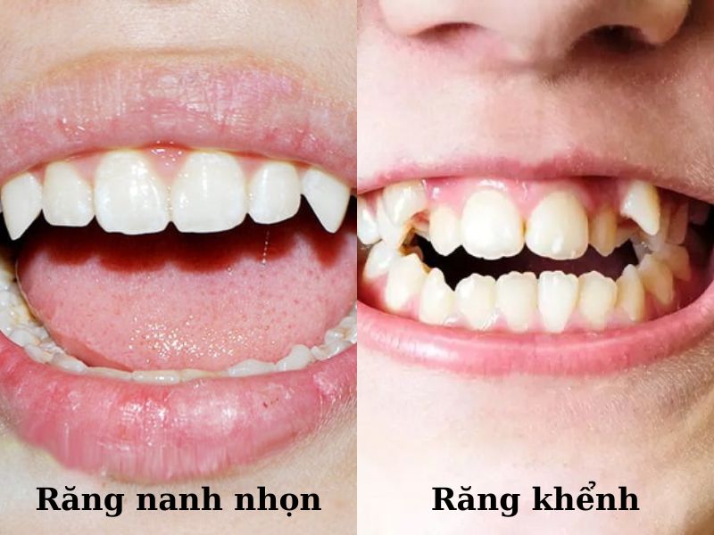 Răng nanh và răng khểnh có hướng mọc không giống nhau