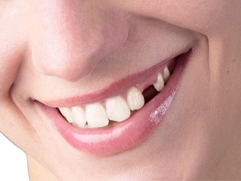 Răng nanh nhọn mọc ngầm là răng mọc trong xương hàm và không chồi ra ngoài
