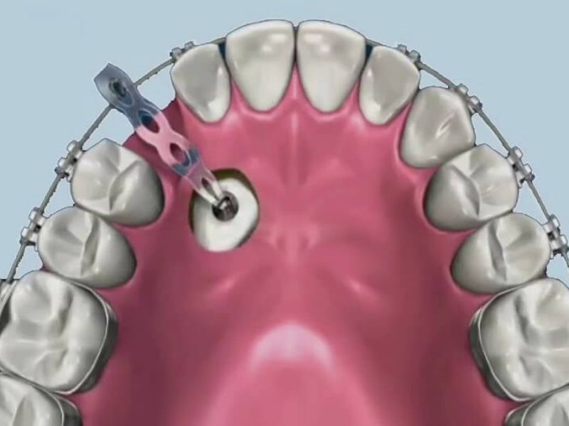 Cải thiện tình trạng răng nanh mọc ngầm bằng phương pháp chỉnh nha