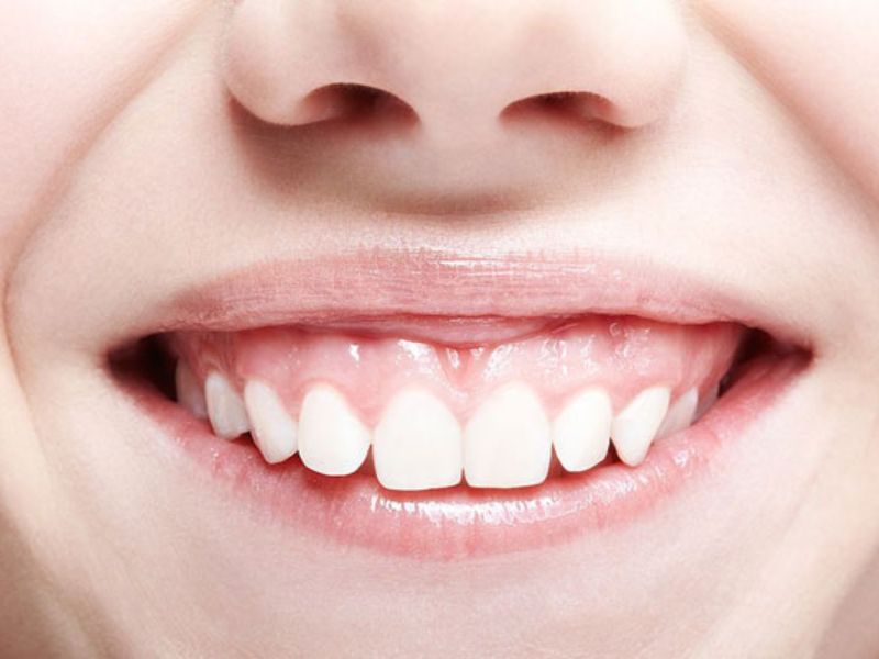 Những thói quen xấu hay yếu tố bẩm sinh cũng có thể gặp phải tình trạng răng ngắn và cười hở lợi