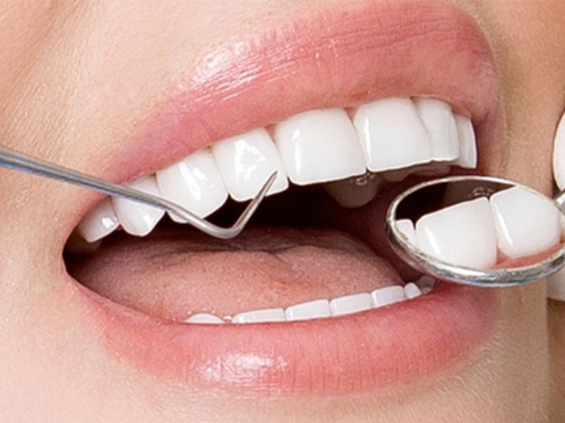 Bọc răng sứ giúp khắc phục hiệu quả tình trạng răng ngắn và lợi bị lộ nhiều khi cười