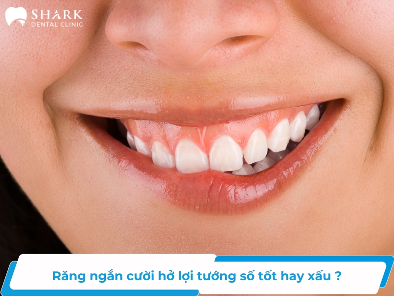 Răng ngắn cười hở lợi tướng số tốt hay xấu ?