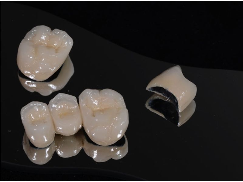 Có 3 loại răng sứ Titan, mỗi loại có một đặc điểm khác nhau