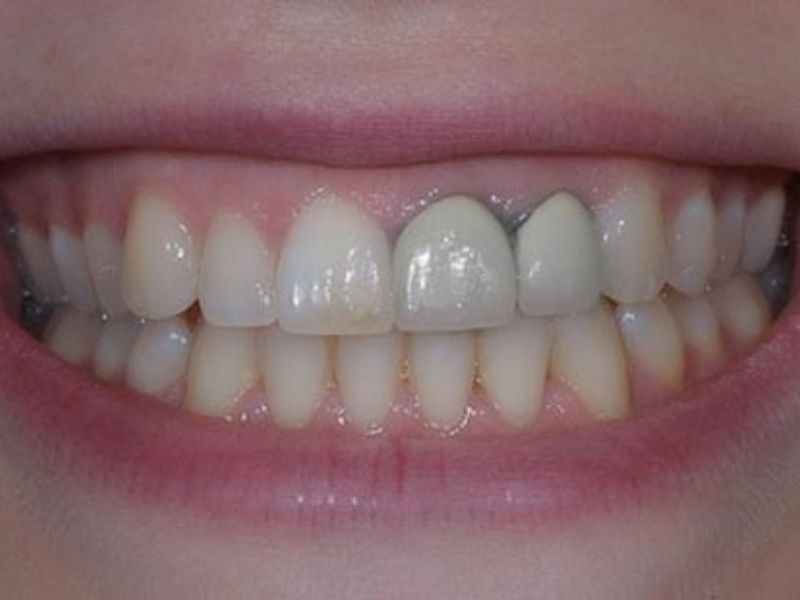 Răng sứ Titan dễ bị viền đen nướu sau một thời gian sử dụng