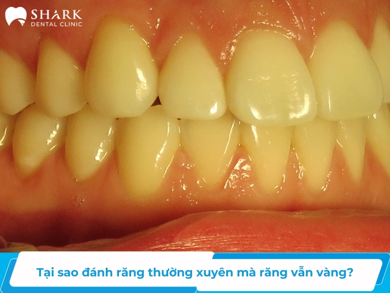 Tại sao đánh răng thường xuyên mà răng vẫn vàng