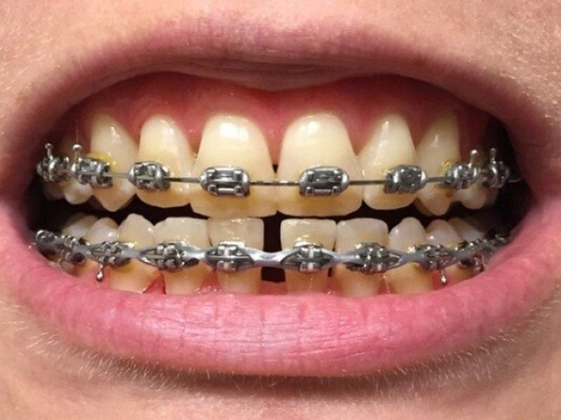 Niềng răng tại những cơ sở nha khoa kém chất lượng thì dây thun niềng răng bị vàng