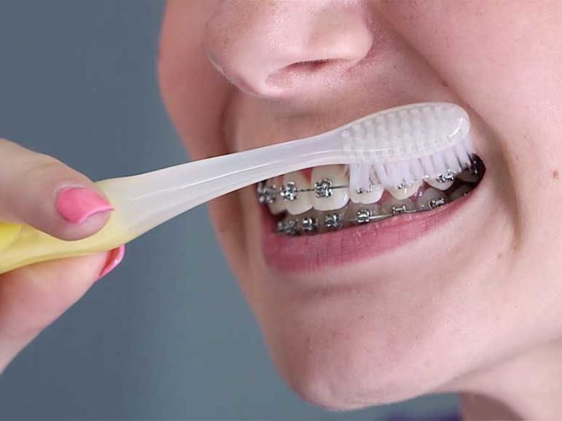 Dây thun niềng răng bị vàng do vệ sinh răng miệng không đúng cách