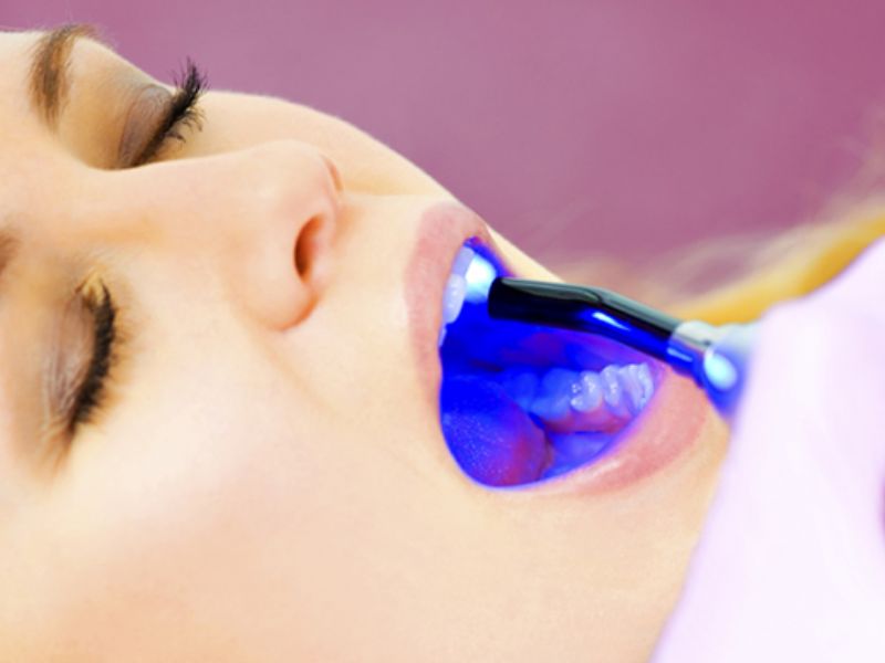 Trám răng bằng composite giúp cải thiện tình trạng răng bị hư tổn và mang tính thẩm mỹ cao