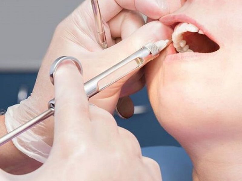 Bác sĩ tiến hành gây tê giúp khách hàng giảm cảm giác khó chịu trong quá trình trám răng
