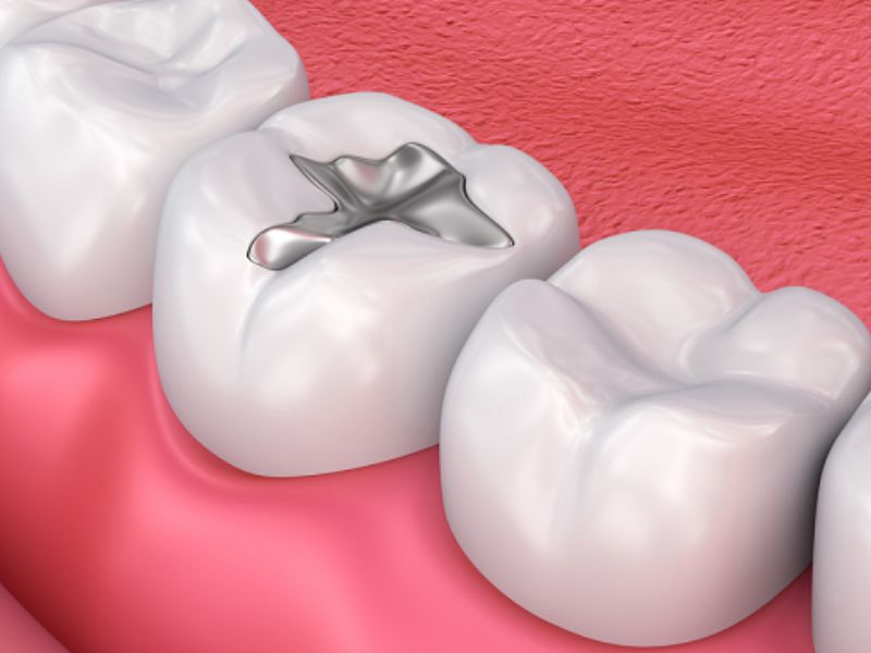 Khi răng sâu nên trám răng để tiết kiệm chi phí điều trị và phục hình răng hiệu quả