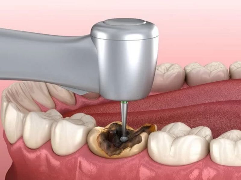 Răng bị sâu nặng và ảnh hưởng tới tủy có thể gây ra tình trạng đau nhức trong quá trình trám răng