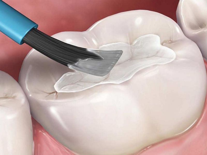 Trám men răng là phương pháp sử dụng các vật liệu trong nha khoa để tráng lên bề mặt răng bị hư tổn như sâu răng