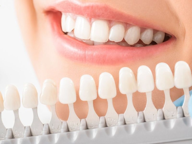 Những trường hợp răng ố vàng, thưa nhẹ,... nên tráng sứ để cải thiện hàm răng