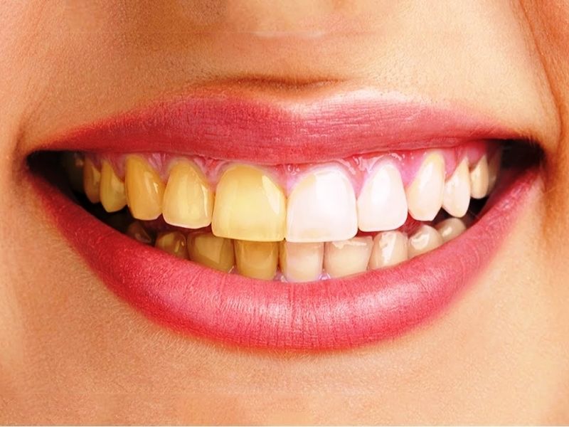 Tráng răng sứ được chỉ định trong các trường hợp răng có kích thước không đều, xỉn màu,....