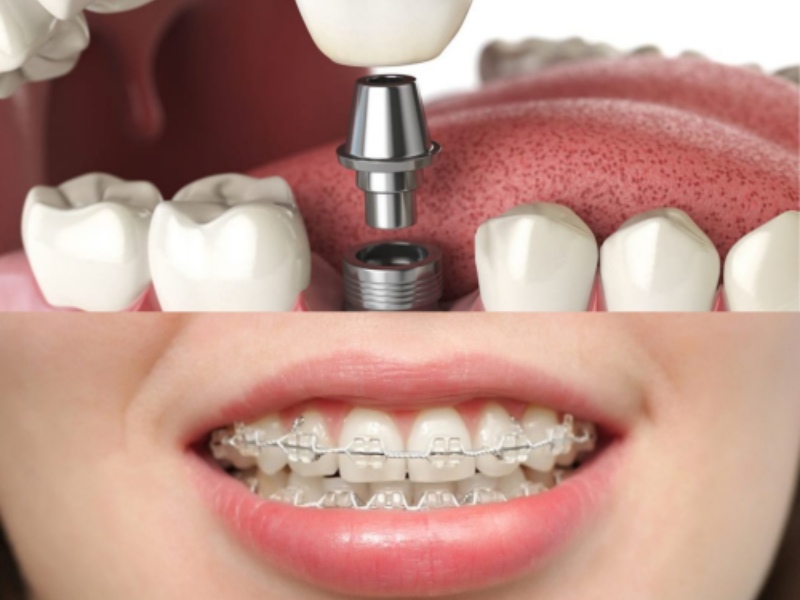 Sau khi trồng răng Implant khó có thể thực hiện niềng răng bởi còn phụ thuộc vào vị trí cấy ghép răng