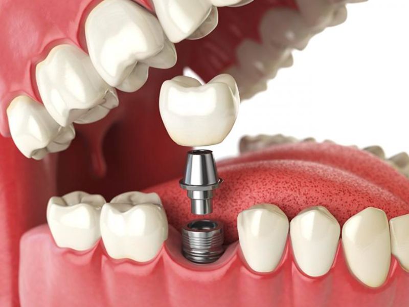 Implant Brat có độ chịu lực tốt, đảm bảo chức năng ăn nhai tốt giống răng thật